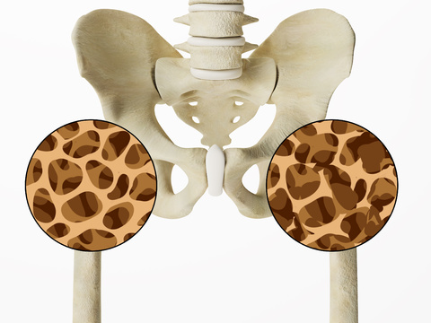 human bone osteoporosis pelvis