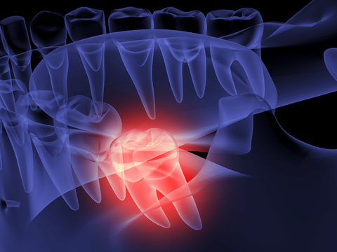 Oral teeth Wisdom teeth